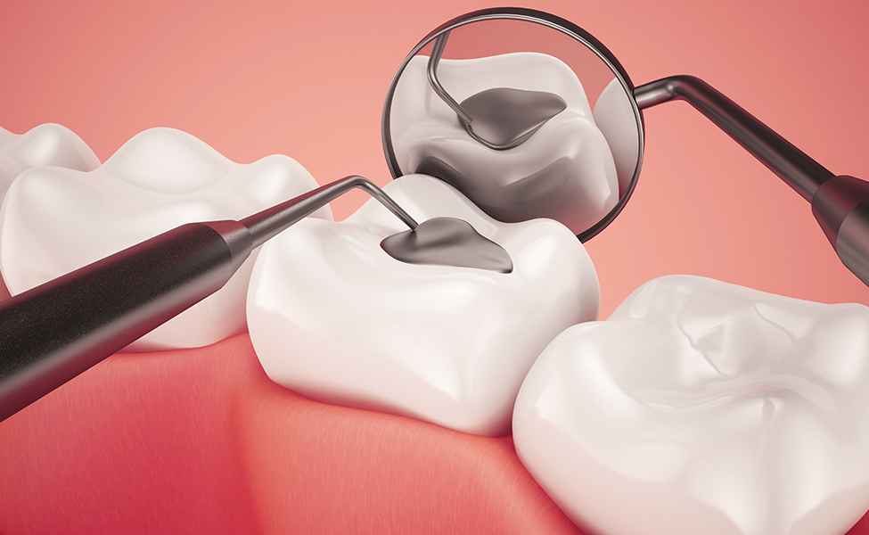 Traitement des caries et soins conservateurs-dr jamila zemrani-temara