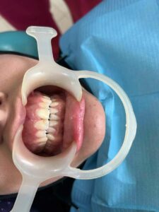 blanchiment dentaire- dr jamila zemrani-Temara