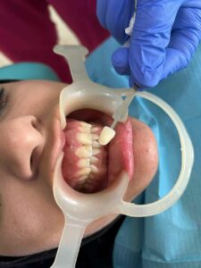 blanchiment dentaire-cabinet dr jamila zemrani