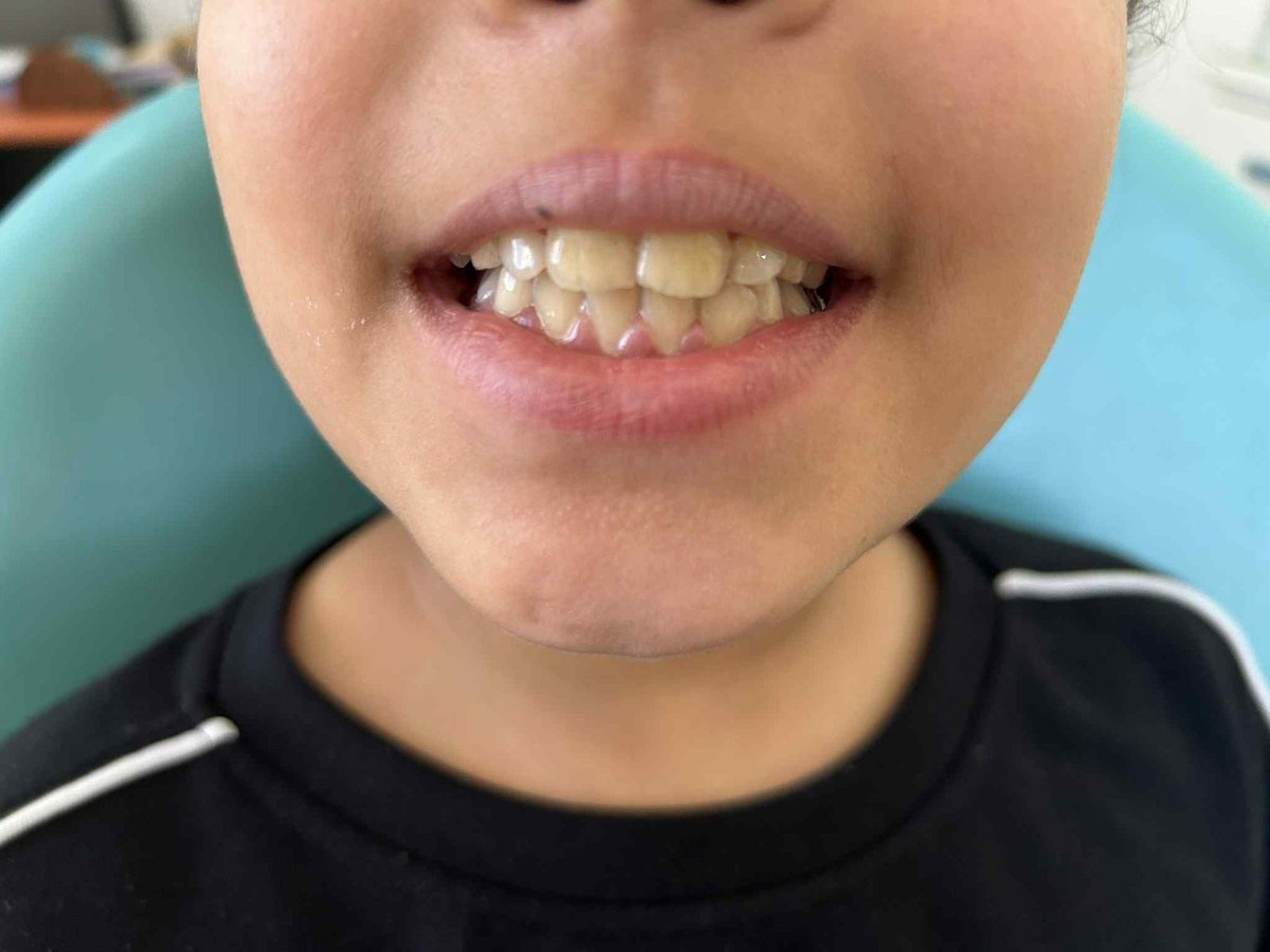 Apres-la-correction-de-locclusion-et-lalignement-dentaire-cabinet-dr-jamila-zemrani-Temara