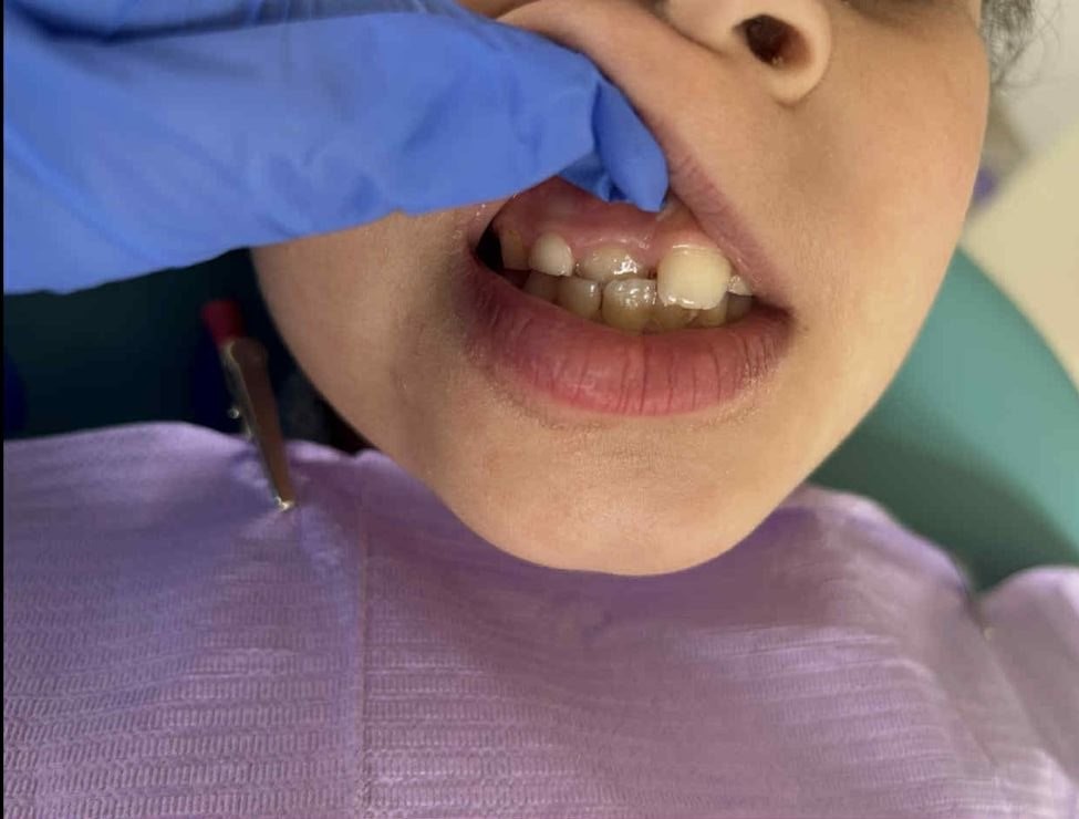 Orrection-de-locclusion-et-lalignement-dentaire-Cabinet-dr-Jamila-Zemrani-Temara