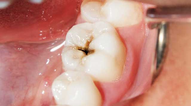 carie dentaire dr jamila zemrani temara-rabat