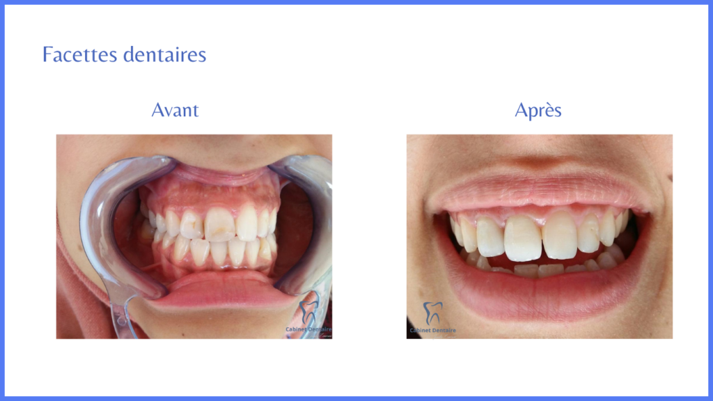 facettes-dentaires-interne-dr-jamila-zemrani-temara
