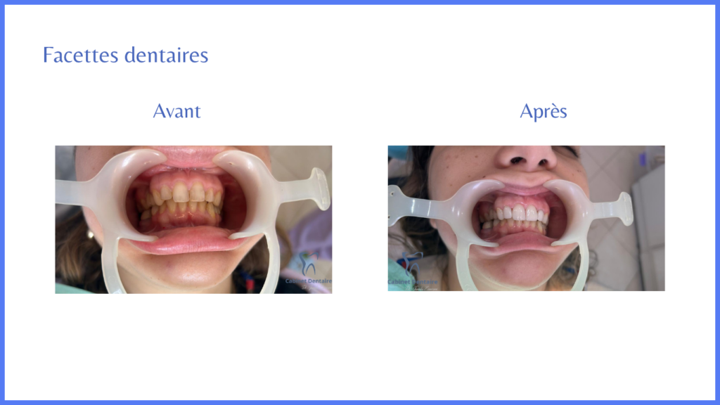 facettes-dentaires-interne-dr-jamila-zemrani-temara-cas-2