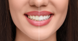 blanchiment dentaire-dentiste-jamila-zemrani-temara