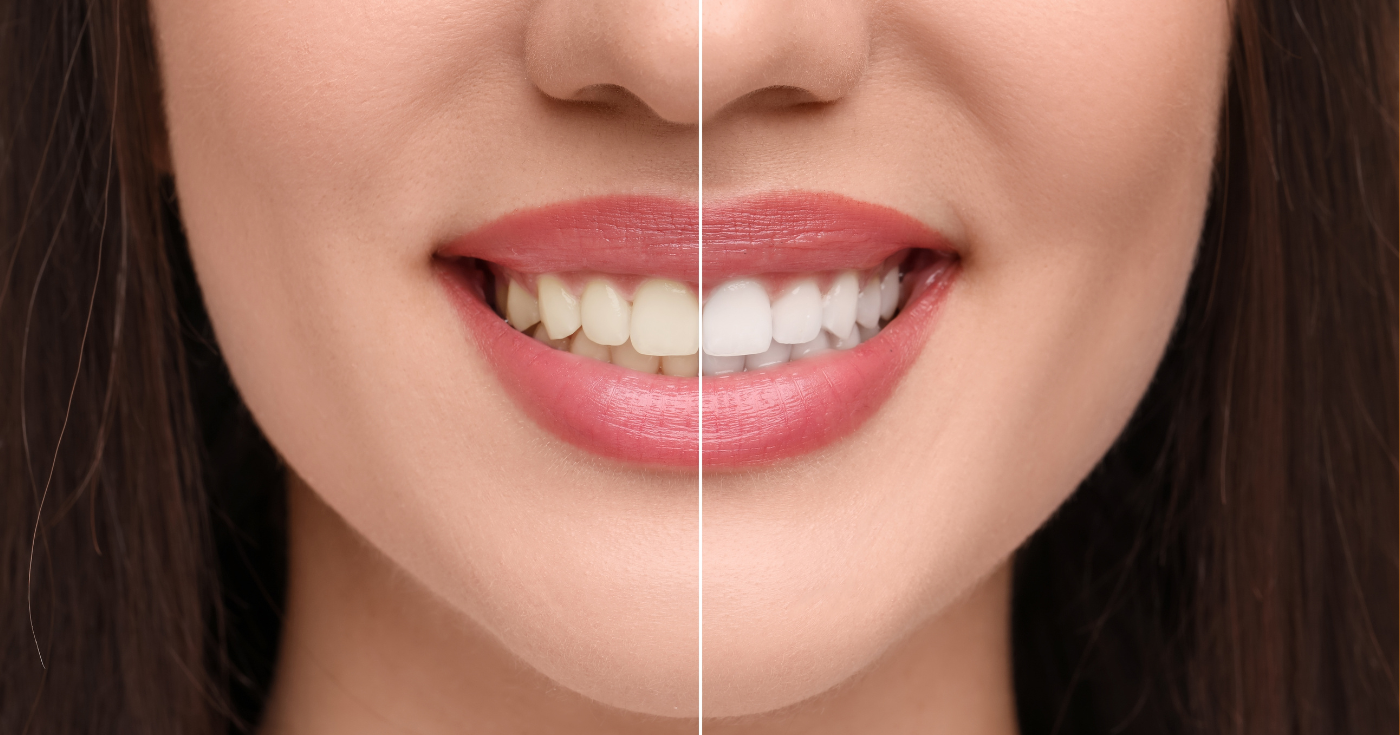 blanchiment dentaire-dentiste-jamila-zemrani-temara