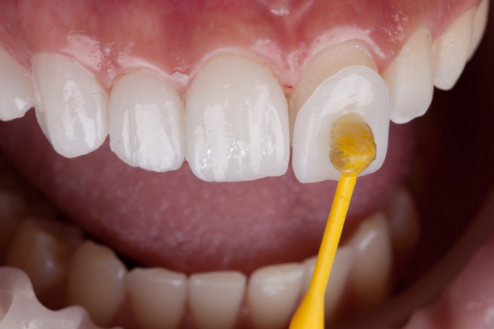 facettes-dentaires-dentiste-dr-jamila-zemrani-temara