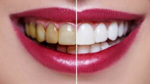 Banchiment dentaire-facettes-dentaire-dentiste-temara
